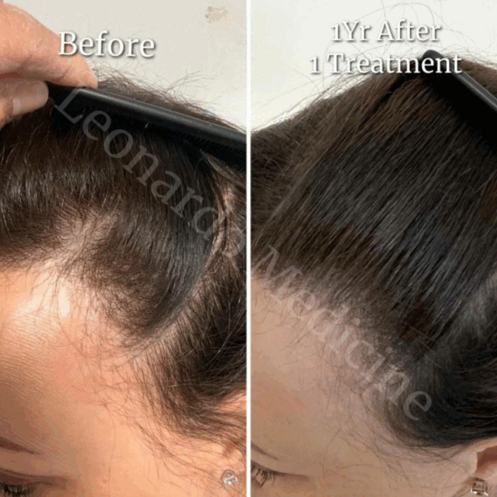 PRP Hair Restoration1