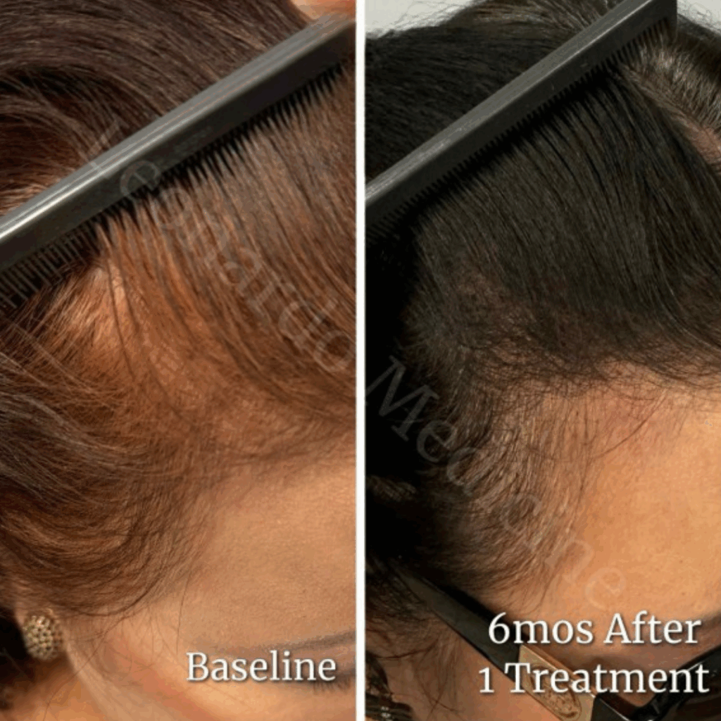 PRP Hair Restoration2