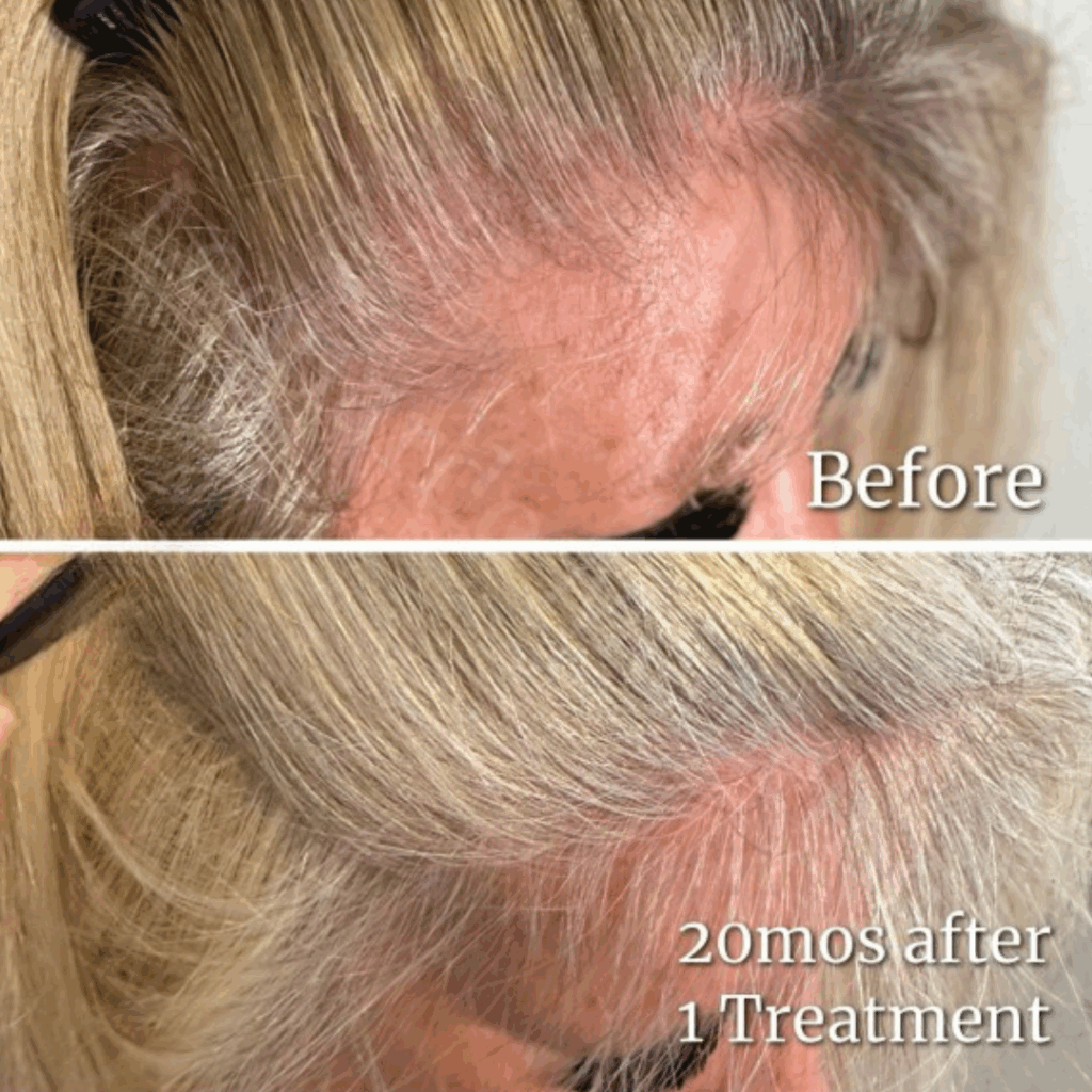 PRP Hair Restoration3
