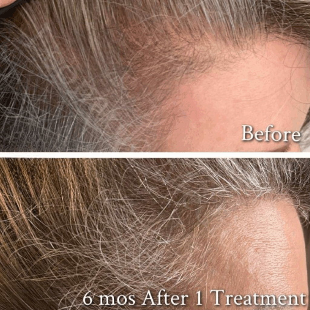 PRP Hair Restoration4