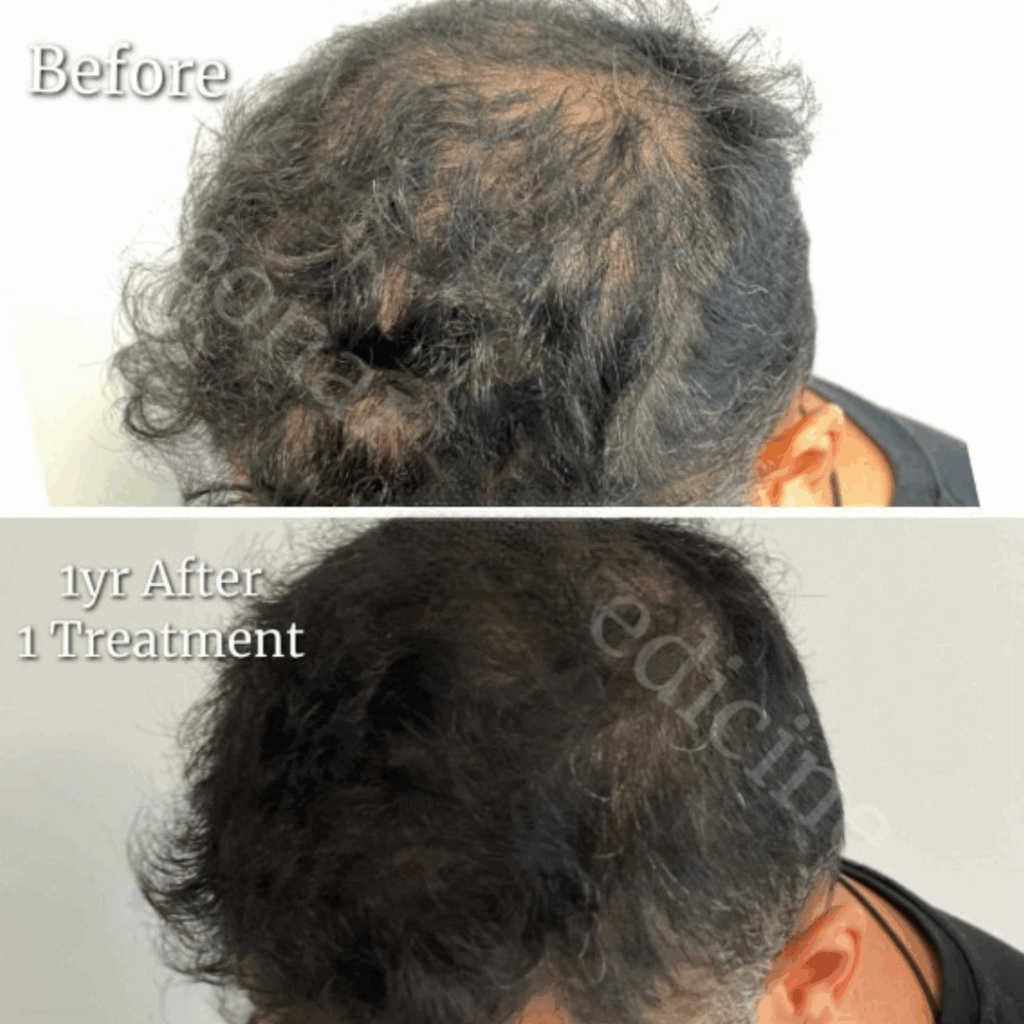PRP Hair Restoration5