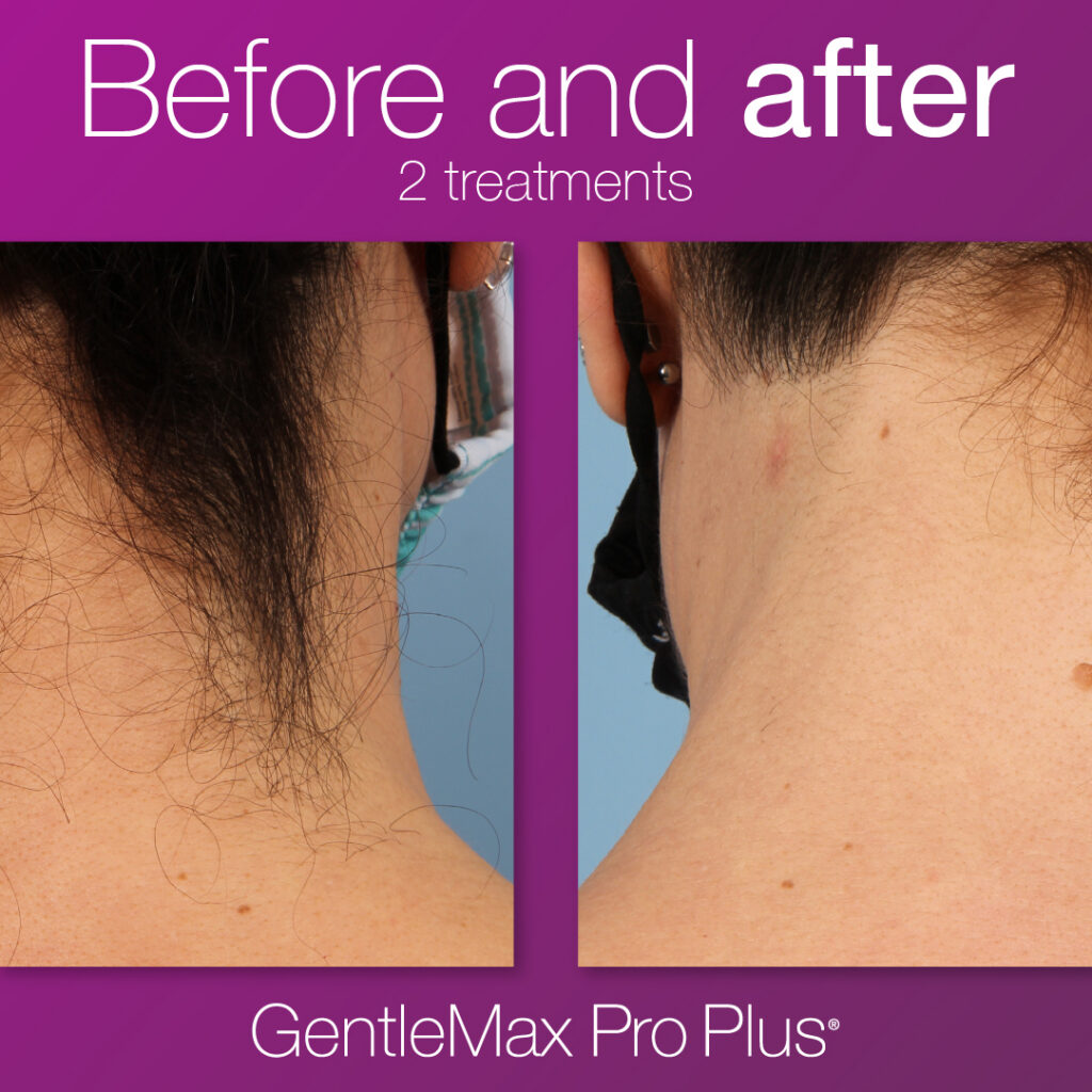 GMPP-Laser-Hair-P8-1