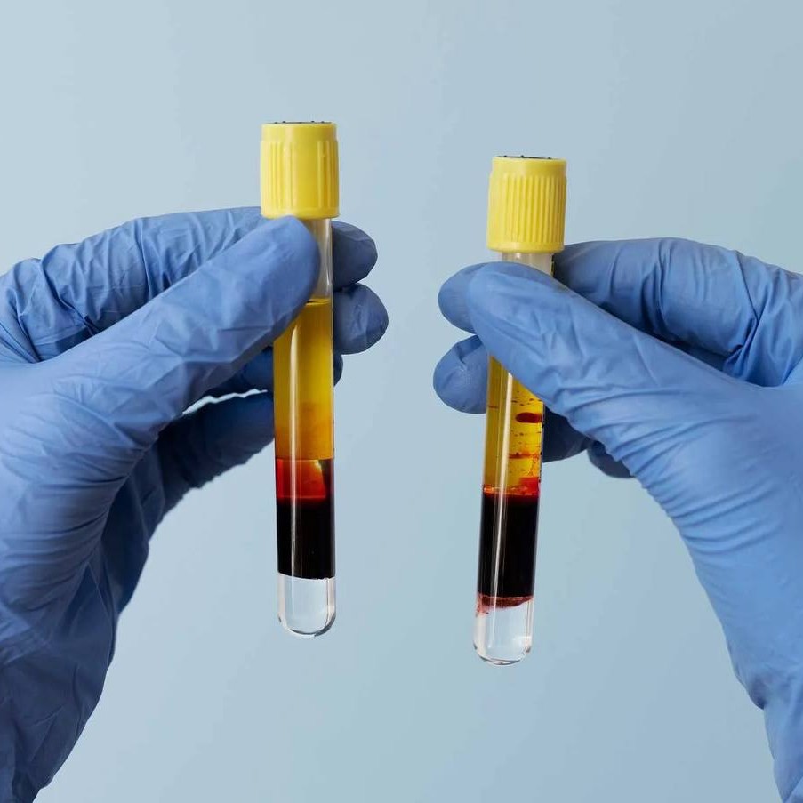 PRP treatment