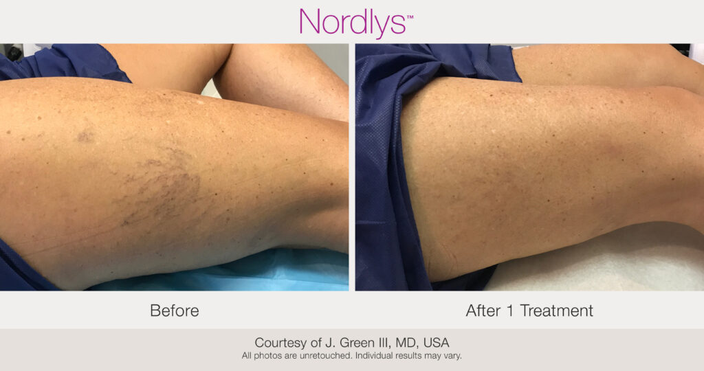 BA-Nordlys-JGreenIII-legveins-1Tx
