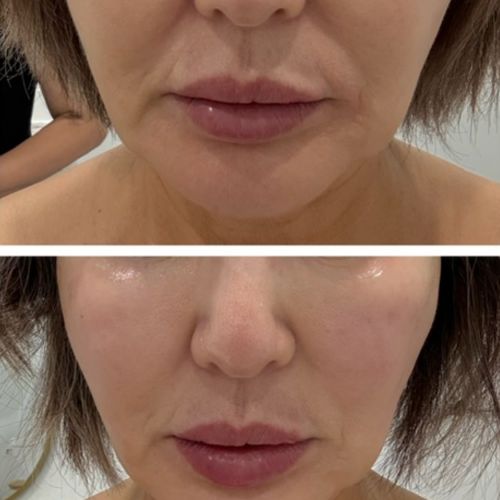 Cynosure Luntronic XERF Skin Tightening