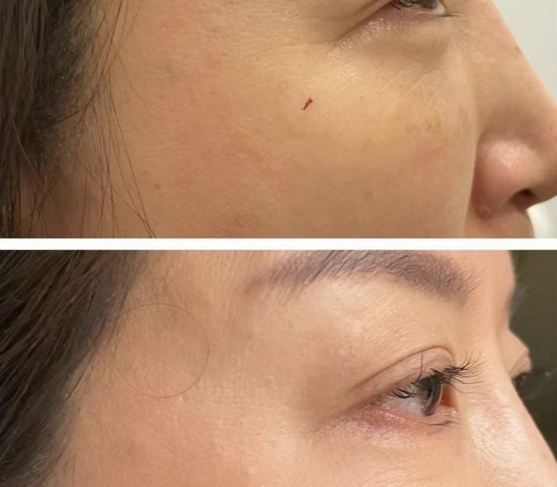 PLEXR Plasma Treatment1