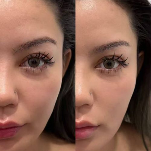 Xerf face lifting